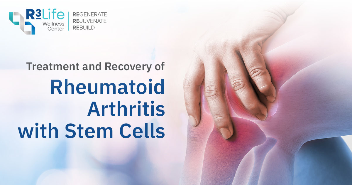 Picture of Treatment and Recovery of Rheumatoid Arthritis with Stem Cells